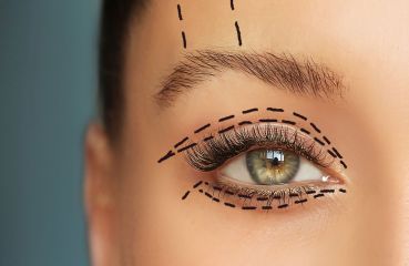Ovisnuté viečka bez klasického skalpela: prečo je laserová blefaroplastika šetrnejšia cesta